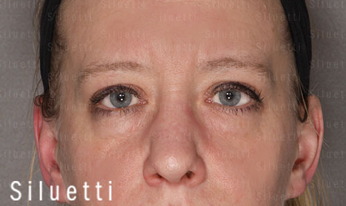Siluetti - silmäluomileikkaus ennen ja jälkeen