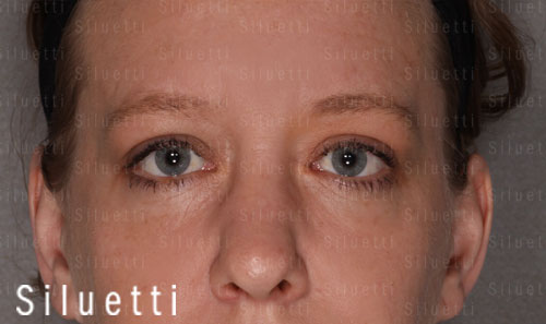 Siluetti - silmäluomileikkaus ennen ja jälkeen